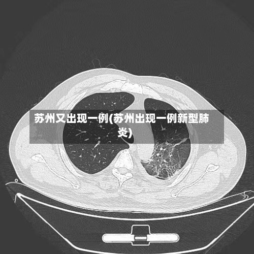 苏州又出现一例(苏州出现一例新型肺炎)