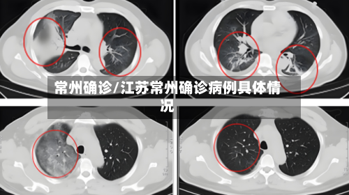 常州确诊/江苏常州确诊病例具体情况